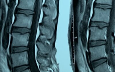 AI Revolution in Spinal Health: Deep Learning Matches Radiologist Expertise in Detecting Axial SpA Inflammation