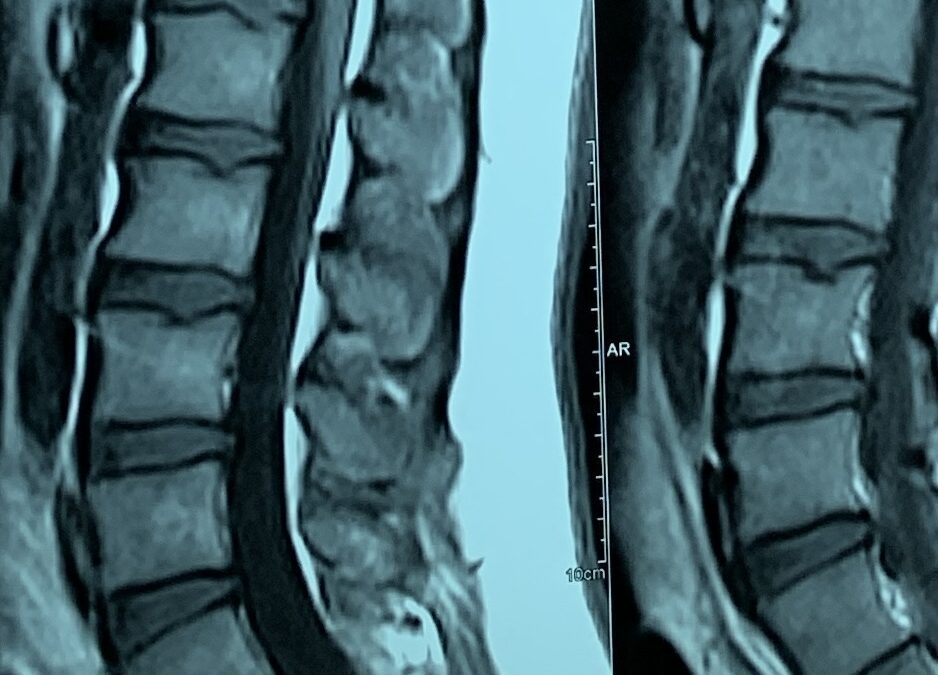 AI Revolution in Spinal Health: Deep Learning Matches Radiologist Expertise in Detecting Axial SpA Inflammation