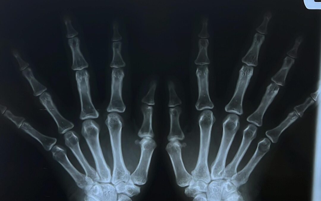 Abatacept and Prevention of Rheumatoid Arthritis