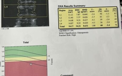 Understanding Your Bone Density Results: A Guide for Everyone