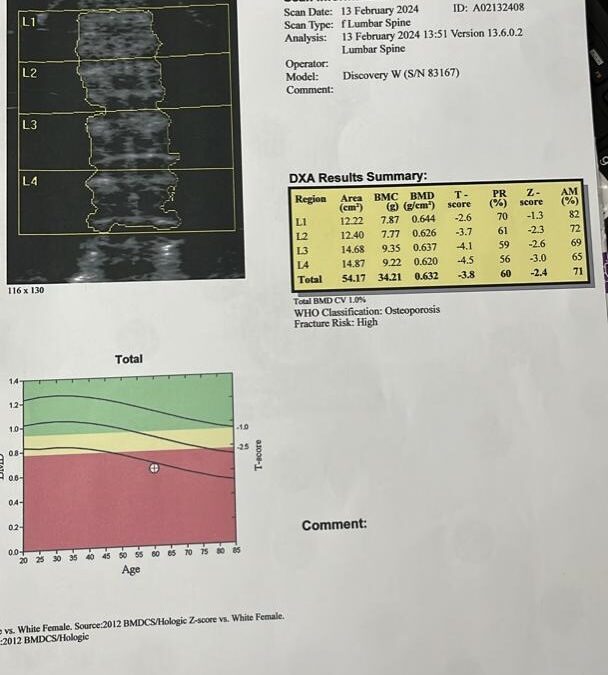 Understanding Your Bone Density Results: A Guide for Everyone