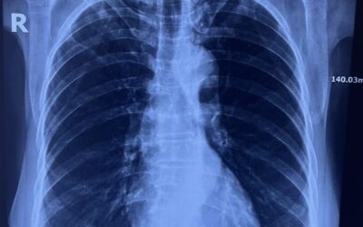 Serositis Showdown: Rheumatoid Arthritis vs. Psoriatic Arthritis – Who Suffers More from Pleuropericarditis?