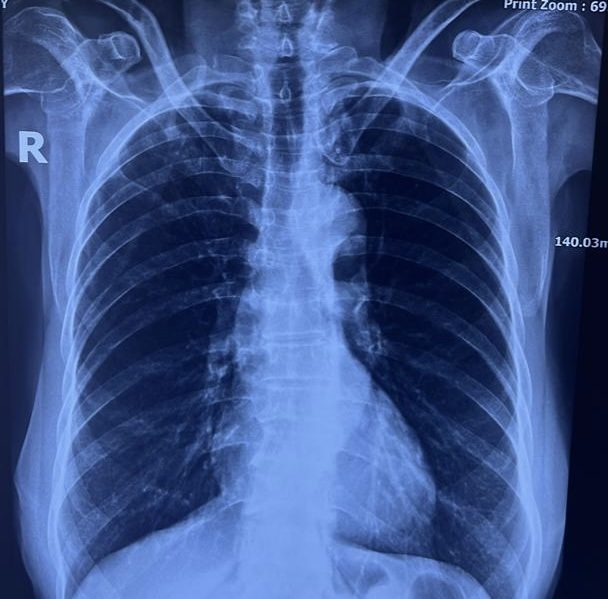 Serositis Showdown: Rheumatoid Arthritis vs. Psoriatic Arthritis – Who Suffers More from Pleuropericarditis?