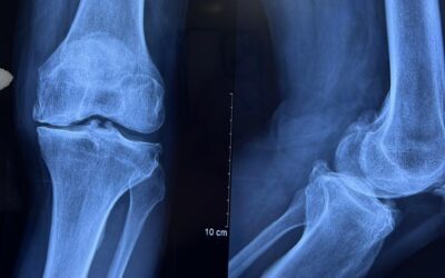 Cutting-Edge Antibody Treatment Shows Efficacy in Knee Osteoarthritis Relief