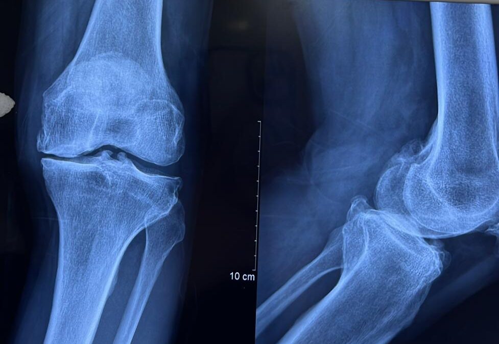 Cutting-Edge Antibody Treatment Shows Efficacy in Knee Osteoarthritis Relief