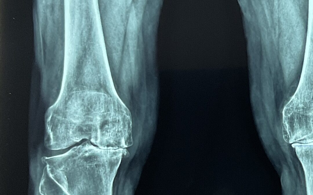 Long-Term Pain Relief: How a Plant-Based Diet Transforms Osteoarthritis Treatment