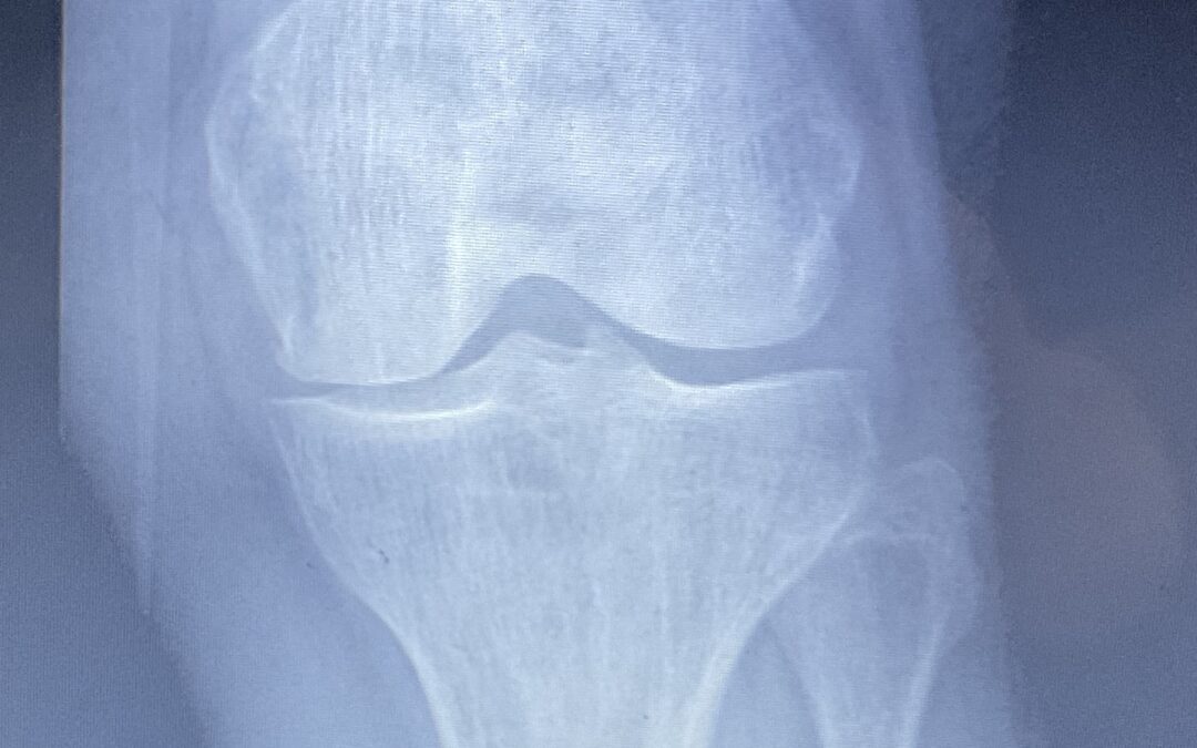 Breaking New Ground: Safe and Effective Gene Therapy for Knee Pain