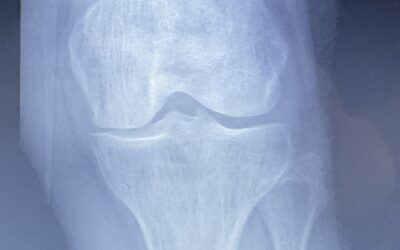 Breaking New Ground: Safe and Effective Gene Therapy for Knee Pain