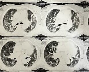 Breathing Easier: How Nintedanib Combats Lung Damage in Connective Tissue Disease