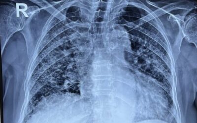 Breathing Uneasy: High Rates of Hidden Lung Issues in Newly Diagnosed Arthritis