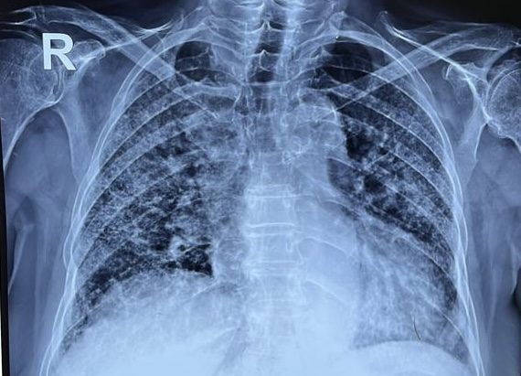 Breathing Uneasy: High Rates of Hidden Lung Issues in Newly Diagnosed Arthritis