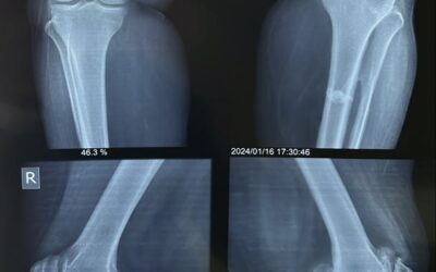 Protecting Joints from Within: How Liraglutide Outperforms Dexamethasone in Osteoarthritis